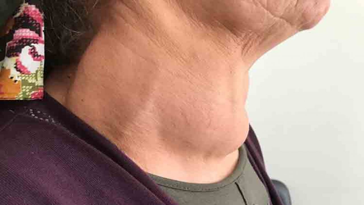 Boğazından çıkanlar doktorları bile hayrete düşürdü! 30 yıldır çekiyordu!