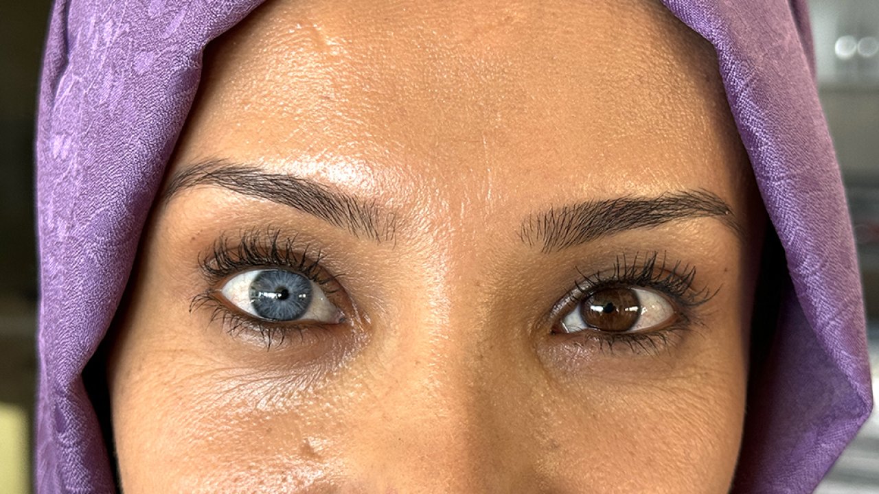 Kahramanmaraşlı Nurhayat gözleriyle büyülüyor! Her kes lens sanıyor!