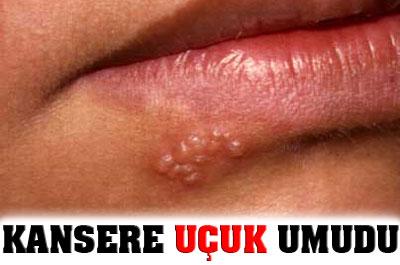 Uçuk yapan herpes virüsü, kanseri alt ediyor