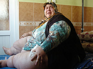 Obezite Hastası Kadın, 260 Kiloya Ulaştı