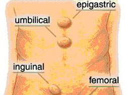 Fıtık erkek hastalığımı? 