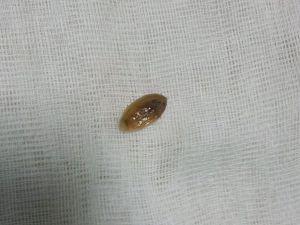 Akciğerinden Fıstık Kabuğu Çıktı