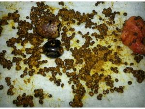 Safra Kesesinden 300 Adet Taş Çıktı