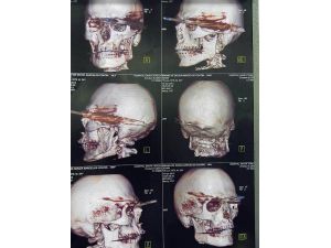 Gözüne Zıpkın Saplandı