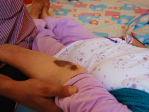 Kolunda İğne Unutmuşlar!