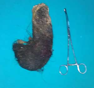 Genç Kızın Midesinden 1 Kilo Saç Çıktı