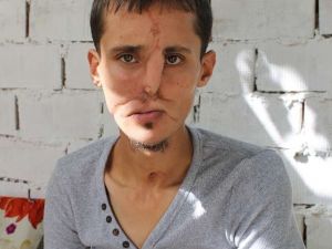 Yüz Nakli Hayali Yarım Kaldı