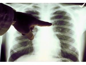 Akciğer Kanserinde Korkutan Değişim