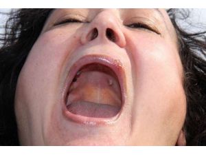 Gözünde Unutulan Suni Damar, Damağından Çıktı