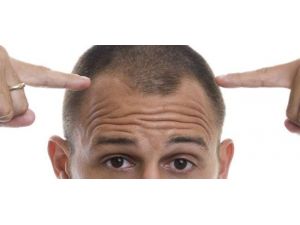 Saç Ekiminde Hedef Doğal Görünüm Olmalı