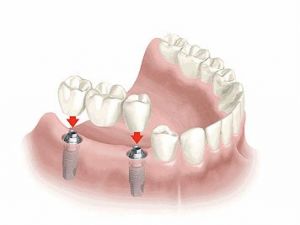Eksik Dişler İçin Yeni Tedavi Yöntemi