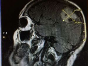 Konuşurken Beynindeki Tümör Alındı