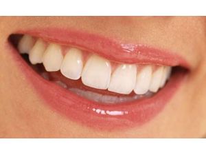 Bozuk Diş Yapısına Telsiz Çözüm