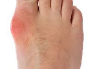 Ayaklardaki Kemik Çıkıntısına Dikkat