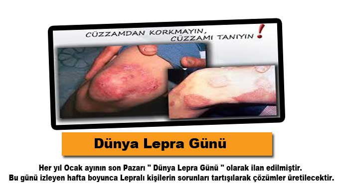 Dünya Lepra Günü