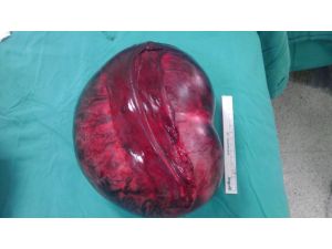 (Özel Haber) Karnından 5 Kilo Kitle Çıkarıldı