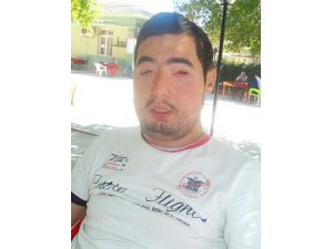 Türkiyenin 4. Yüz Nakli Olan Turan Çolak: