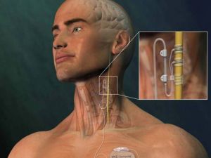 Epilepsi Nöbetlerine “Pilli” Çözüm