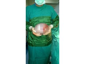 74’lük Hastanın Karnından 5 Kilogram Ur Çıktı