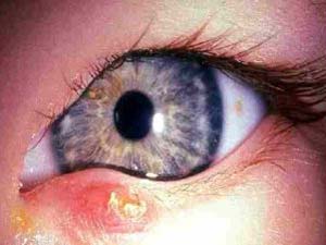 Gözde Oluşan Arpacığa Sarımsak İyi Gelmez