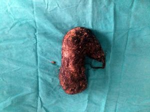 Midesinden 850 Gram Saç Çıktı