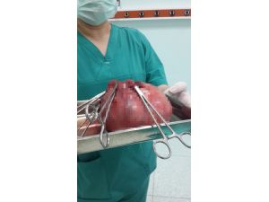 Rahminden Dört Kiloya Yakın Cisim Çıkarıldı