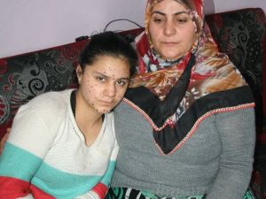13 Yaşında Cilt Kanserine Yakalandı