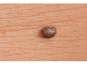 Benlerde Çirkin Ördek Belirtisine Dikkat !