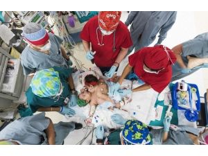 Siyam İkizleri 26 Saatlik Operasyonla Ayrıldı