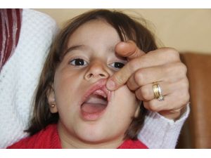 (Özel Haber) Dişleri Eriyen Nazlıcan Yardım Bekliyor