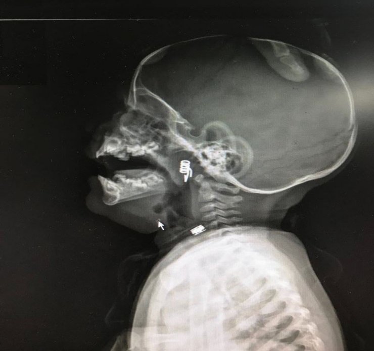 Boğazına yay kaçan bebek ölümden döndü