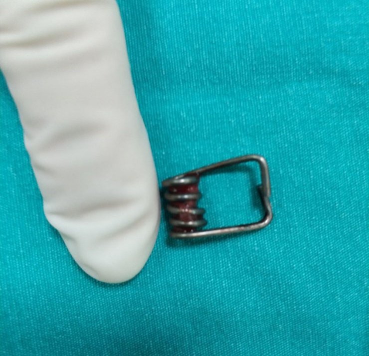 Boğazına yay kaçan bebek ölümden döndü