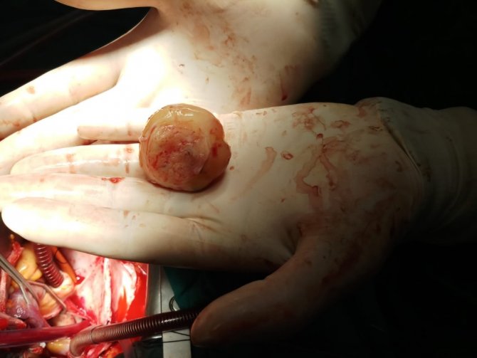 Kalbinden 6 santim çapında kitle çıkarıldı