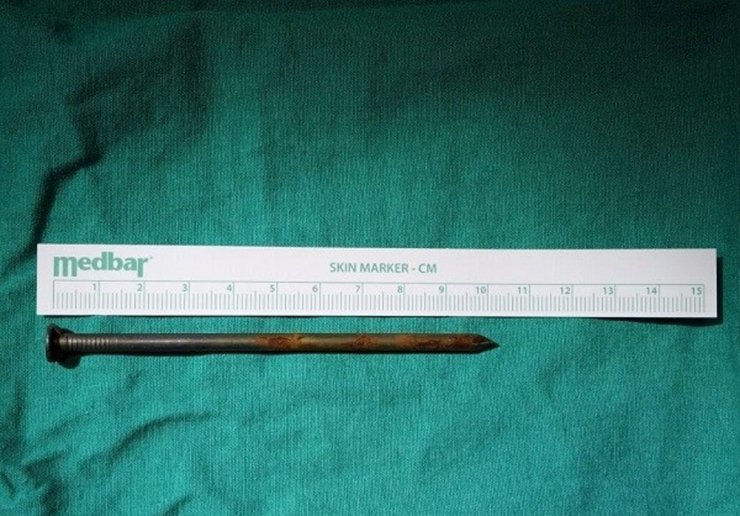 Soluk Borusuna 10 Santimlik Çivi Kaçırdı