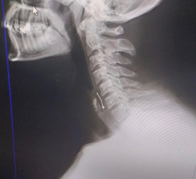 Doğum günü pastası yerken boğazına toplu iğne saplandı